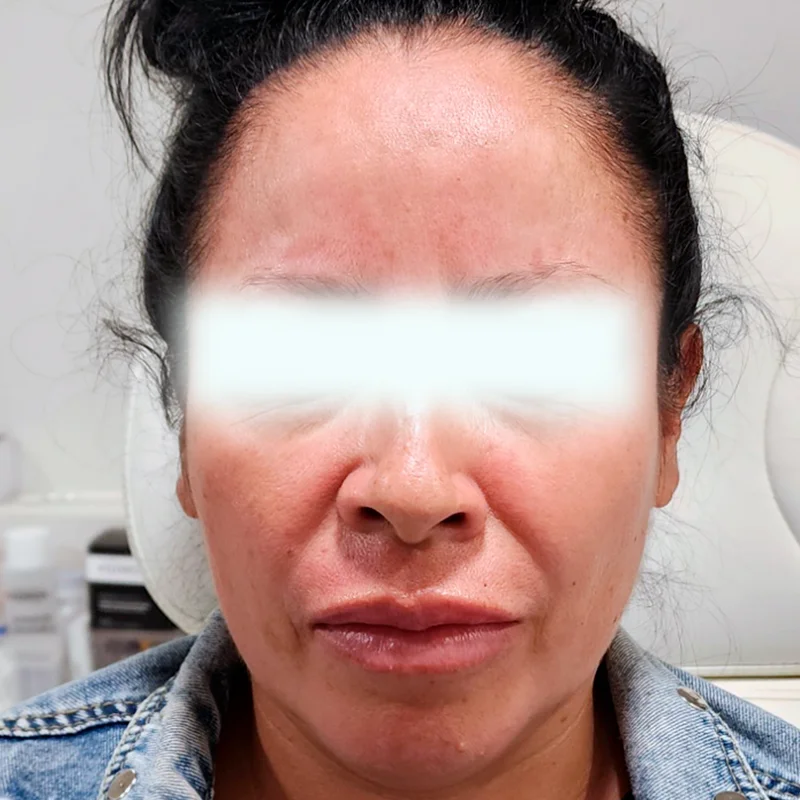Toxina Botulínica - Caso 1 — Después del tratamiento