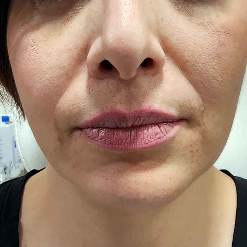 Relleno de Labios - Caso 1 — Antes del tratamiento