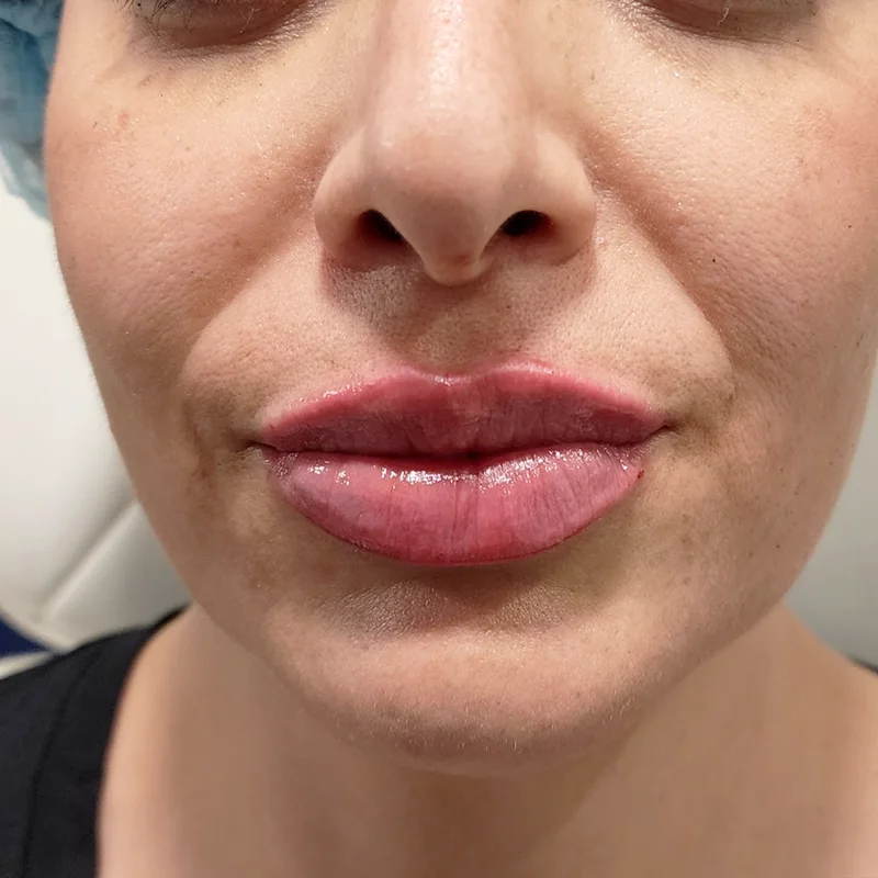 Relleno de Labios - Caso 1 — Después del tratamiento