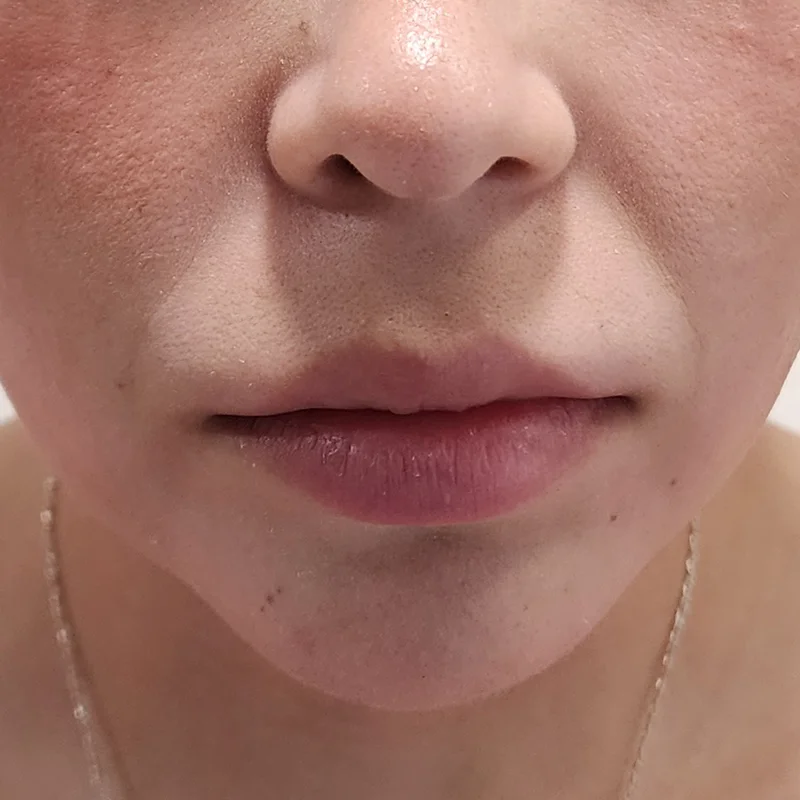Relleno de Labios - Caso 2 — Antes del tratamiento