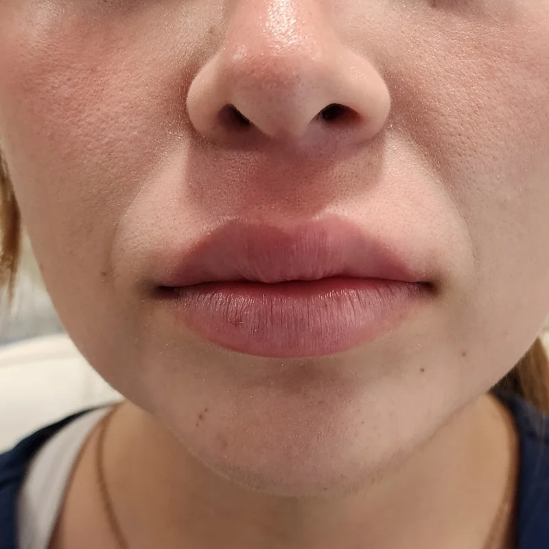 Relleno de Labios - Caso 2 — Después del tratamiento